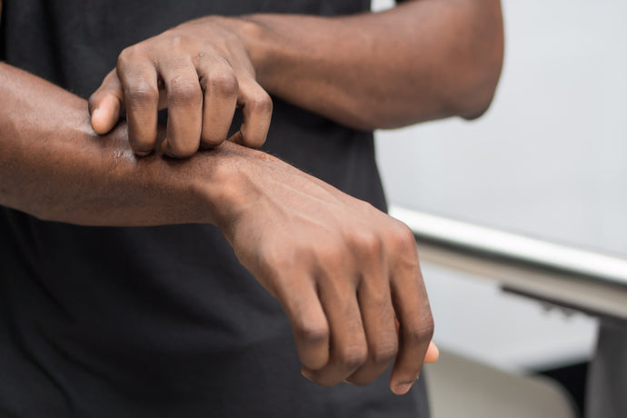The Effects of Eczema on People of Colour