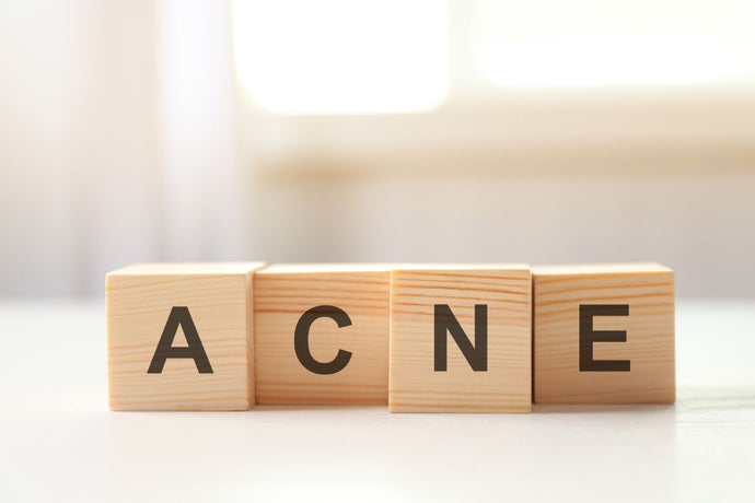 Acne overview