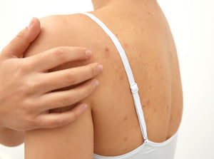 How To Get Rid of Back Acne: Products and Treatments  back acne