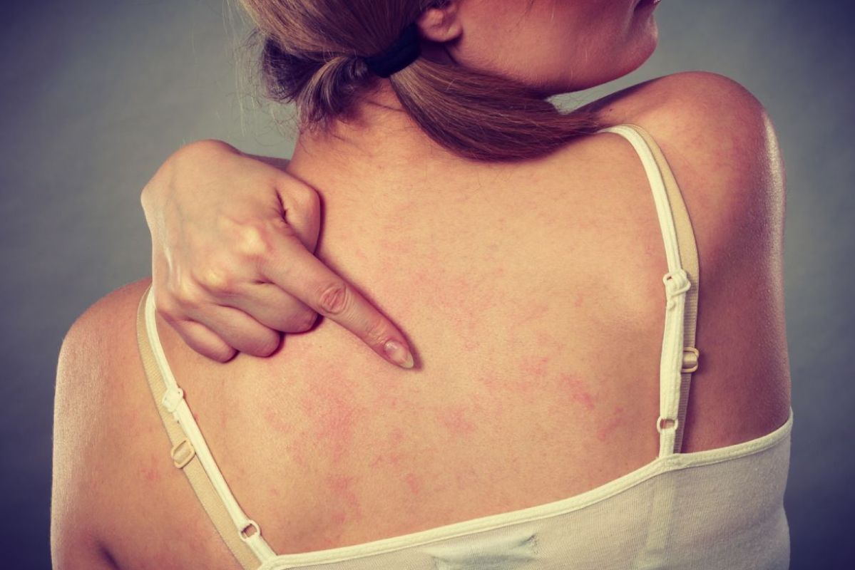 How to Treat Chest and Back Acne Sönd