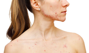 Causes & treatments of acne on different parts of the face
