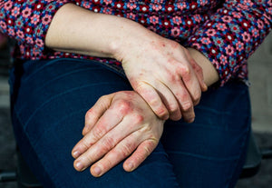 What causes eczema