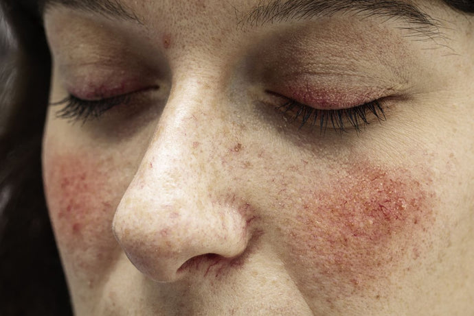 Causes of rosacea